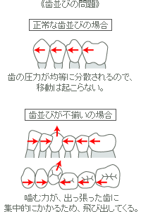 歯並びの問題