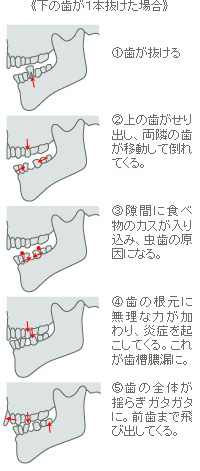 下の歯が１本抜けた場合