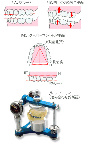 ダイナパーティー（石膏模型による診断）