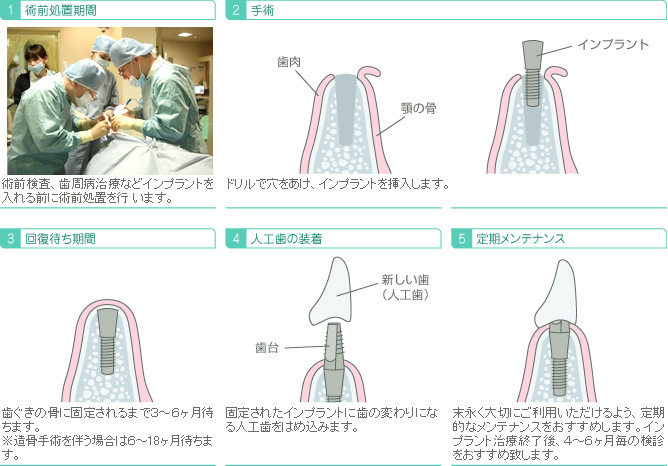 インプラント 手術