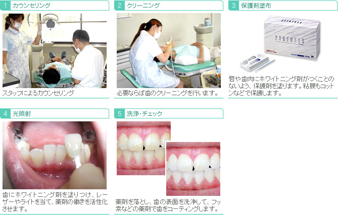 ホワイトニング 唇や歯肉にホワイトニング剤がつくことが無いよう保護剤を塗ります。粘膜もコットンなどで保護します。 歯にホワイトニング剤を塗り、レーザーやライトで薬剤の活性化をさせます。 薬剤を落とし、歯の表面を洗浄して、フッ素などの薬剤で歯をコーティングします。